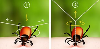 Удаление клеща ниткой