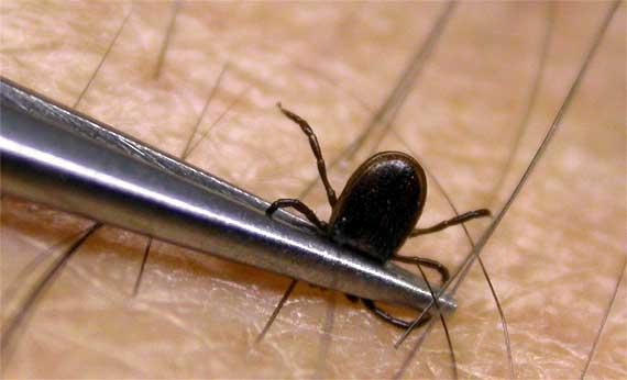 Удаление клеща пинцетом